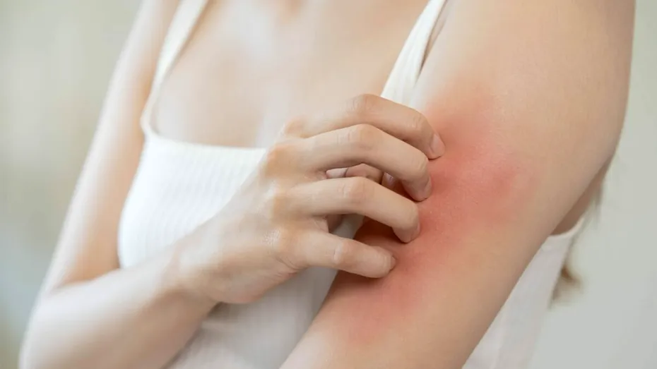 Dermatita atopică: 10 soluții care te ajută să oprești mâncărimea