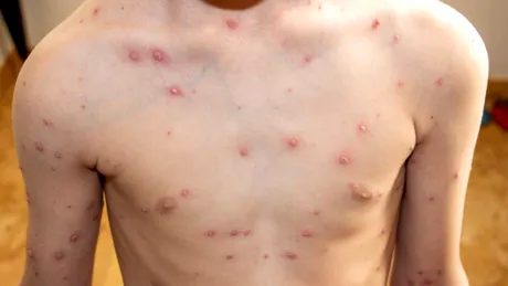 Rujeola, mai aproape de un tratament? Cercetătorii au identificat anticorpi care neutralizează virusul