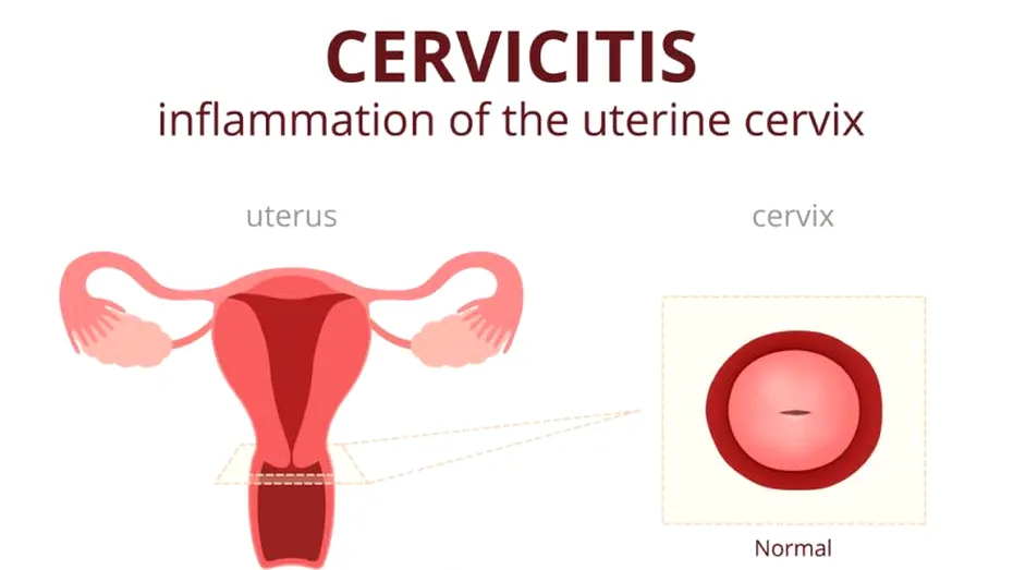 Cervicita: simptome si tratament