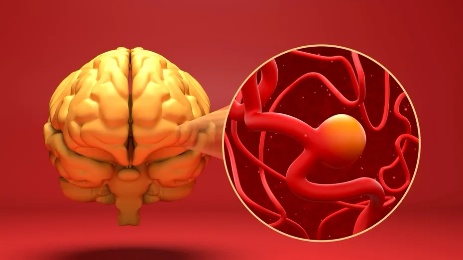 (P) Anevrismul cerebral: tratament minim invaziv prin neuroradiologie intervențională