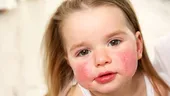 Alergiile alimentare la copii: simptome, cauze, tratament