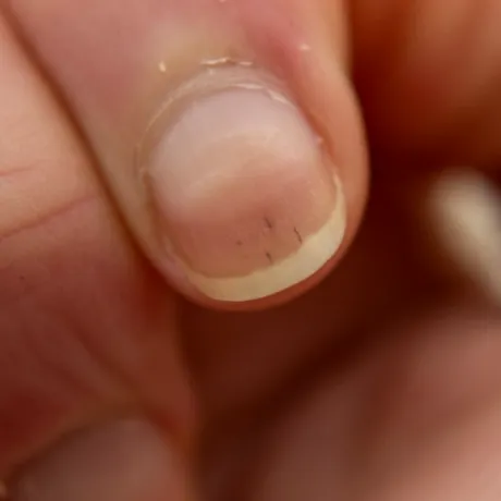 Semnele pe care le dau unghiile de la mâini și de la picioare când ai probleme cu rinichii