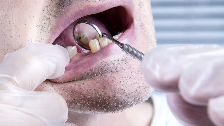 Cum poate fi prevenită boala parodontală, cea mai gravă și răspândită boală a danturii care duce la pierderea dinților