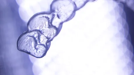 Aparatul dentar clasic versus Invisalign: îngrijire, restricţii, costuri