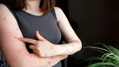 Mpox se răspândeşte cu rapiditate. Boala poate fi fatală și afectează deja 16 ţări