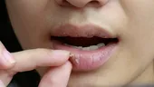 Cum tratezi natural buzele uscate și crăpate. Remedii naturale care vindecă buzele iarna
