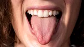 Limba cu margini ondulate („scalloped tongue”): Ce spune acest semn despre sănătatea ta?