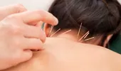 Acupunctura nu mai este recomandată în cazul durerilor de spate