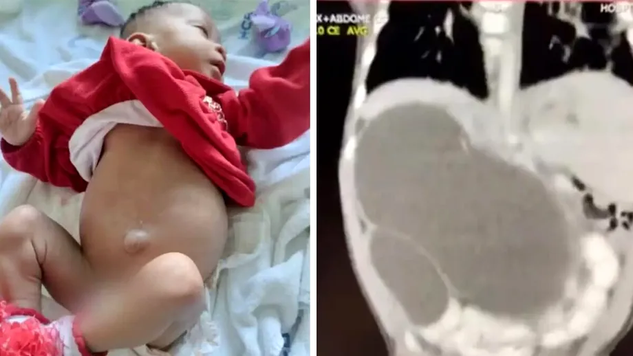 Caz rarisim în istoria omenirii. Acest bebeluș s-a născut cu 4 rinichi. Care e cauza