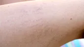 De ce NU trebuie să ignori venele sparte de pe picioare