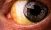Ziua Mondială de Luptă împotriva Hepatitei: Ochii, „fereastra” către sănătatea ficatului. Ce legătură există între hepatită și vedere