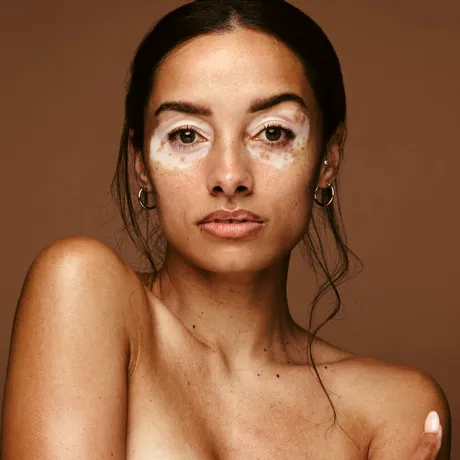 Totul despre Vitiligo. Din ce cauze apare? Unde se formează petele pe piele? Se tratează vitiligo?