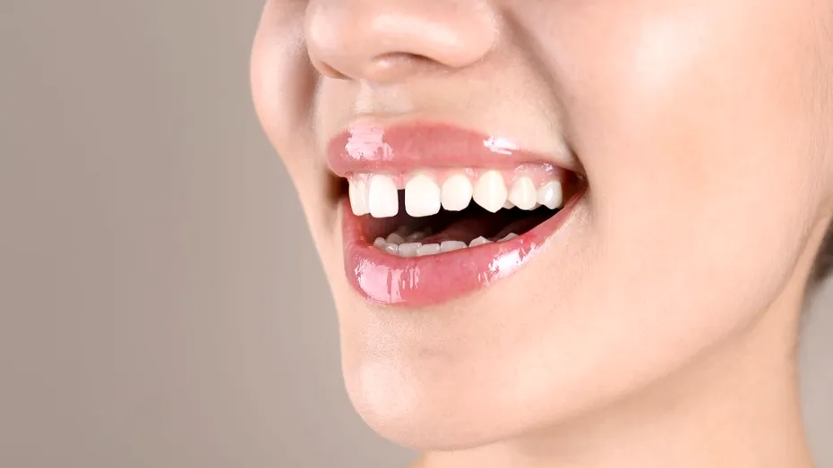 De ce apare strungăreața și cum poate fi corectată