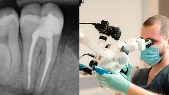 (P) Durerea de masea si tratamentul de canal: cand poate fi util microscopul dentar