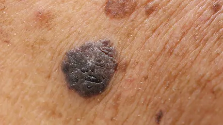 Melanom, cel mai periculos cancer de piele: semne şi tratament