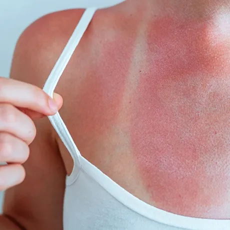 Cum tratezi corect o arsură solară. De ce nu e bine să pui aloe vera pe piele