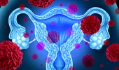 Cancerul de col uterin: infecţia cu HPV şi tratament