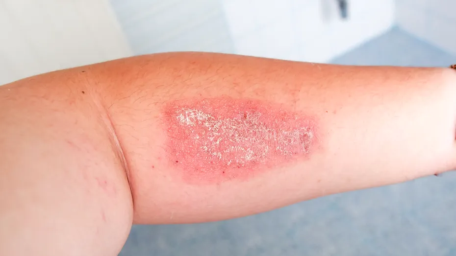 De la locul de joacă, la lenjeria din hotel. Cele mai banale locuri în care se poate transmite stafilococul auriu