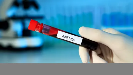 O româncă din trei este anemică și nu știe