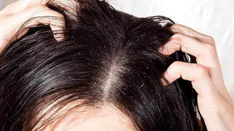 Scalp uscat? Remedii naturale care chiar funcționează