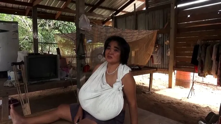 Femeia cu cei mai mari sâni naturali din lume suferă, de fapt, de o boală neobișnuită