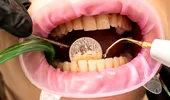 Adevărul nerostit despre tartru: „uităm” să ne spălăm pe dinți cu zilele! Cum scăpăm de placa dentară fără durere
