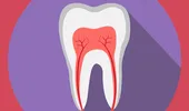 Scoaterea nervului dintelui: când este necesară