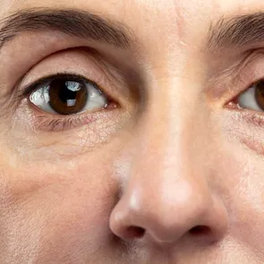 De ce părem obosiți și îmbătrâniți chiar dacă dormim suficient. Pielea din jurul ochilor, cea care ne trădează!