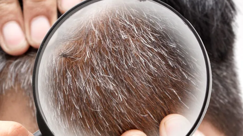 Cercetătorii au descoperit de ce stresul albeşte părul