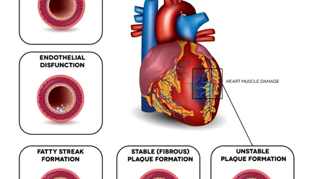 Ateroscleroza: simptome, tratament