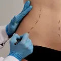 De ce „slăbirea” burții prin liposucție poate schimba proporțiile corpului