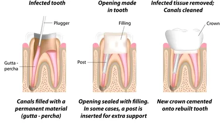 Ce inseamna tratamentul endodontic sub microscop – de ce este folosit, ce trebuie sa stie pacientul
