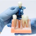 (P) Îngrijirea după implant dentar: reguli simple care pot susține rezultatul pe termen lung