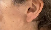 Ce boli dermatologice pot crește riscul de cancer de piele. „Este foarte important să fii examinat de medic”