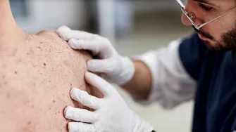 Boala „pielii de fluture”, afecțiunea rară care poate transforma viața într-o luptă zilnică. Cazul dramatic al unui bărbat cu acest diagnostic