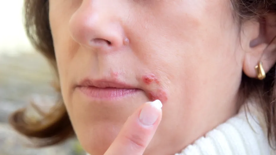 Remedii simple și eficiente împotriva herpesului. Ce funcționează cu adevărat și când trebuie să acționezi