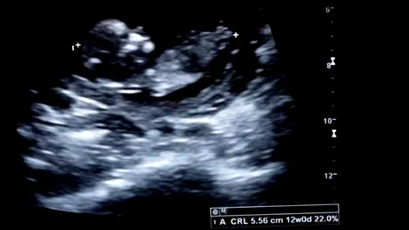Incredibil! Ce a arătat ecografia unei gravide cu gemeni - VIDEO
