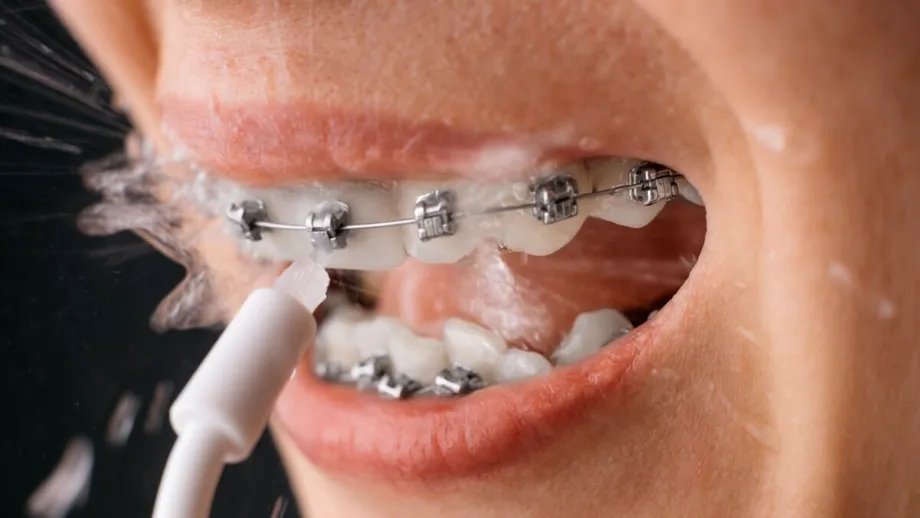 Sfaturi privind igiena orală după montarea aparatului dentar