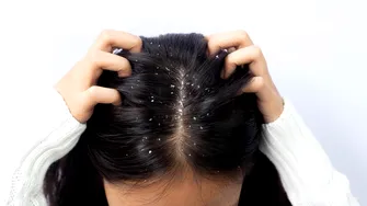 Cum să scapi de mătreață pentru totdeauna. Obiceiul sănătos pentru scalp