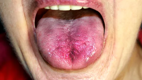 Ai limba roșie? Ce boli ascunde