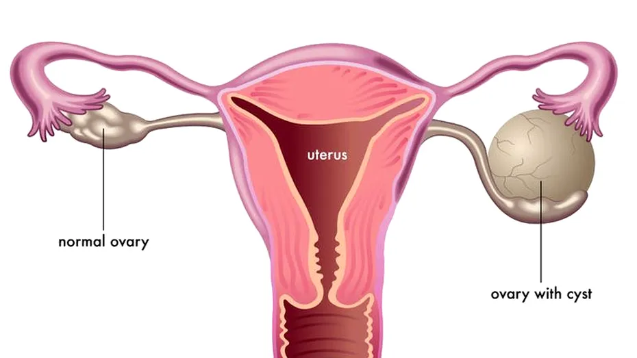 Chist ovarian: simptome, tratament