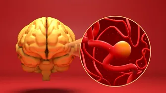 (P) Anevrismul cerebral: tratament minim invaziv prin neuroradiologie intervențională