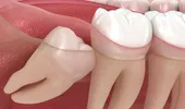 Doare extracția măselei de minte? Medicul stomatolog explică la ce să te aștepți și cum decurge recuperarea
