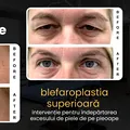 (P) Blefaroplastia superioară: de ce a devenit operația de pleoape cea mai realizată intervenție estetică din lume