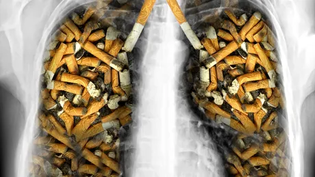 Primul simptom în cancerul pulmonar nu e tusea! Altceva trebuie să te îngrijoreze