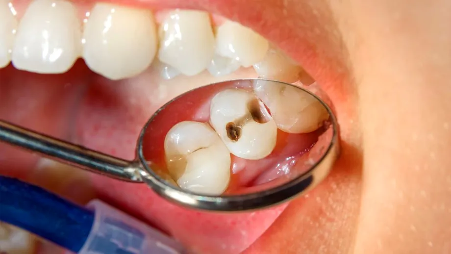 Știai că există mai multe tipuri de carii dentare și că cele negre nu sunt cele mai periculoase?