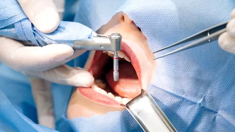 Mini implant ortodontic – ce este, cum se inserează și ce rol are