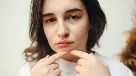 Metoda sigură prin care poți stoarce coșurile fără a-ți lăsa cicatrici pe piele