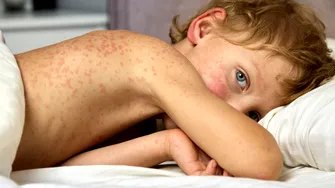 Organizația Mondială a Sănătății, noi alerte din cauza focarelor de rujeolă. România se plasează pe primul loc din Europa la numărul de îmbolnăviri și decese / VIDEO