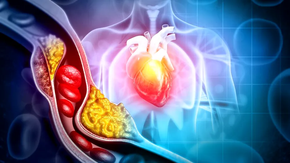 Poți face infarct chiar dacă ai colesterolul normal? Ce spun medicii despre riscul pe care analizele nu îl arată